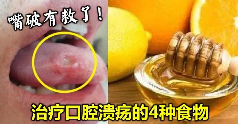 嘴破有救了!治疗『口腔溃疡』的4种食物,转发出去给更多人知道!